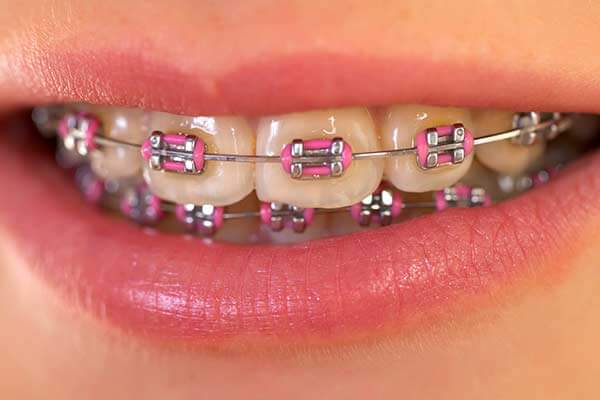 Braces Photo