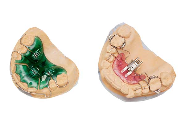 Palatal Expander